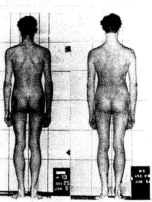 Рис. 7. Фигура до (слева) и после (справа) лечения по Александеру. Фотография слева показывает напряженные мышцы на основании шеи, поднятые плечи и напряженные ягодицы. После лечения эти напряжения исчезли и даже оказался выше ростом (From Barlow, 1973.)